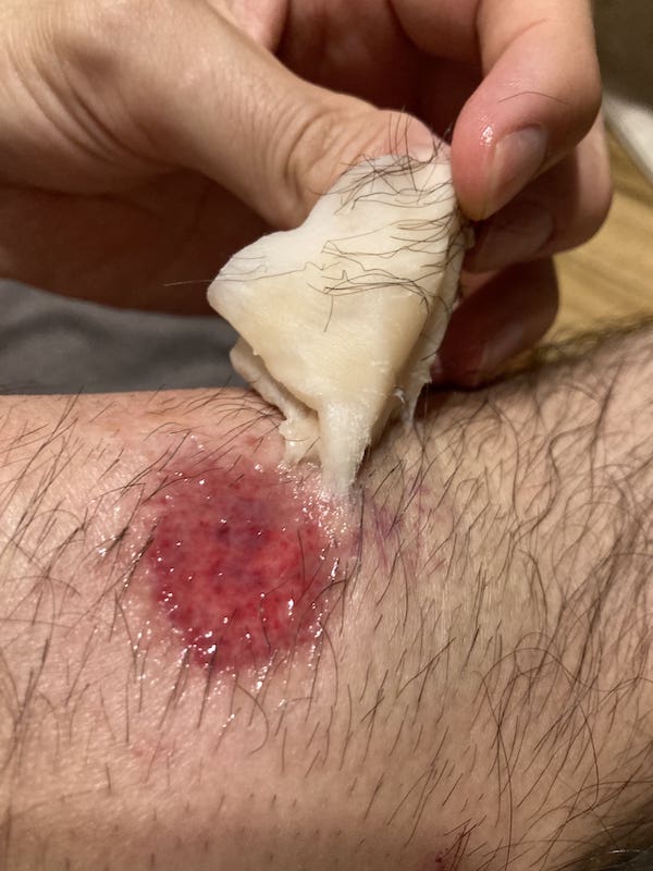 すね毛をそのままに傷口にキズパワーパッドを貼って剥がしたときの悲劇